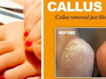 callus-peel-treatment-wiltshire