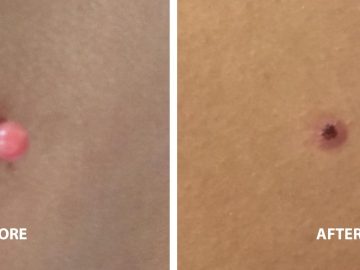 skin-tag-removal-wiltshire